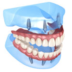 השתלת שיניים בשיטה הבזאלית