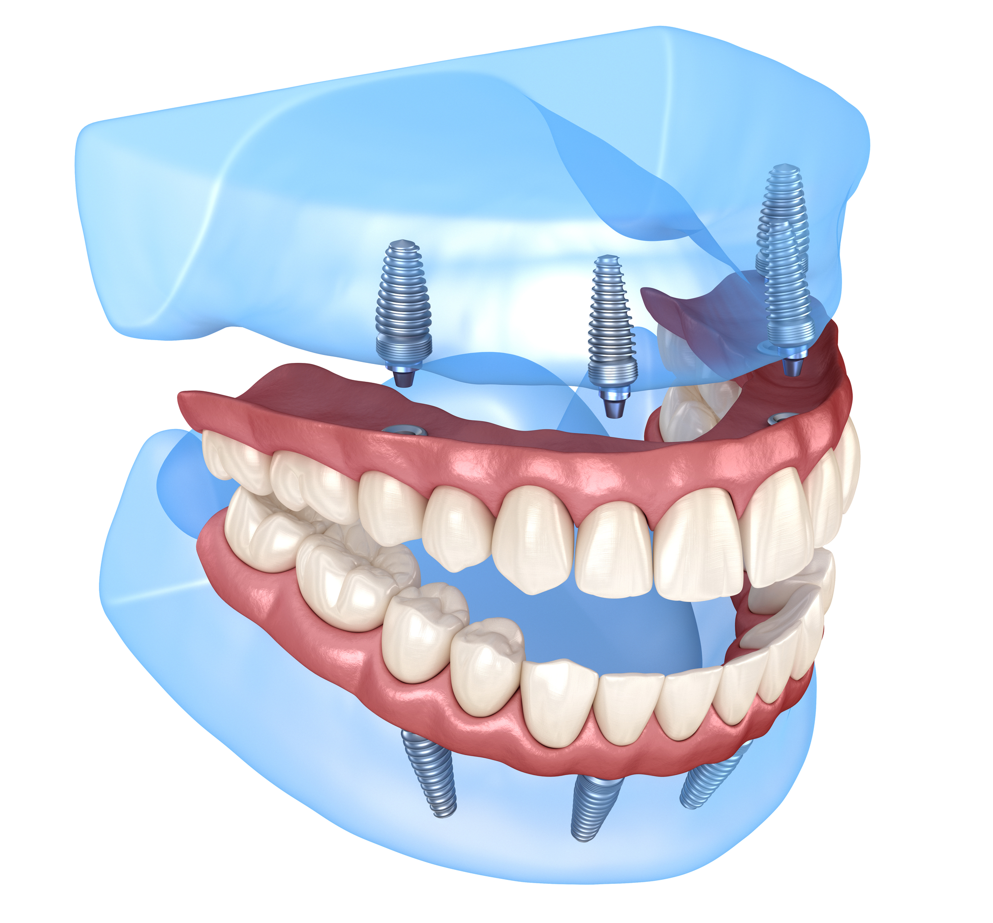 השתלת שיניים בשיטה הבזאלית